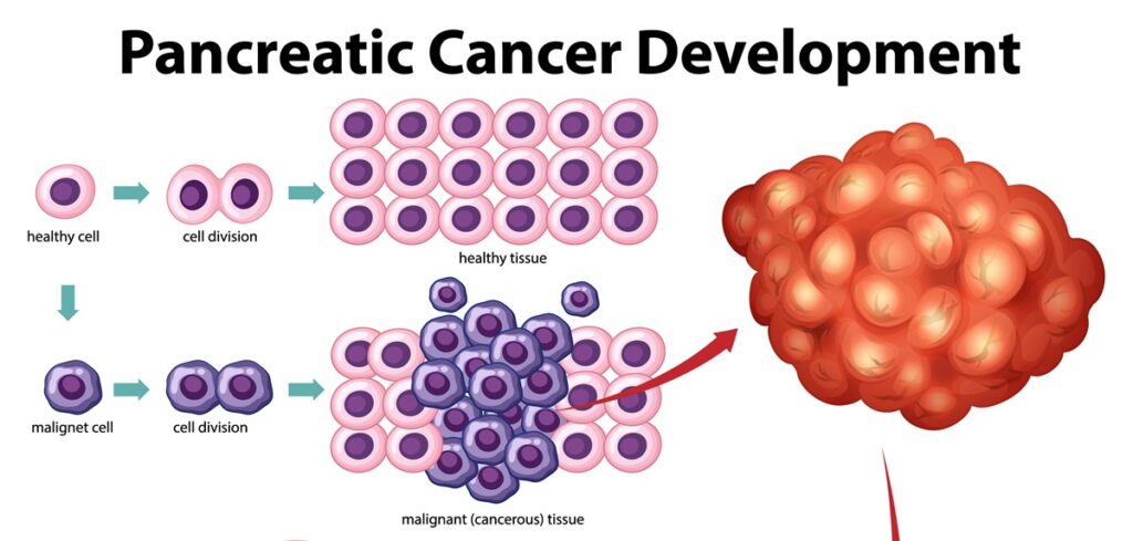 Pancreatic Cancer Sign , Pancreatic Cancer Treatment,Pancreatic Cancer